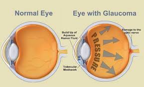 Glaucoma is usually, but not always, the result of abnormally. About Glaucoma Zoomax Low Vision Aids