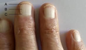 Terry's Nails • LITFL • Medical Eponym Library
