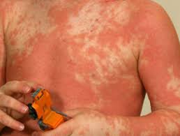 Pityriasis rubra pilaris (prp) is a rare skin disease. Pityriasis Rubra Pilaris Dermnet Nz