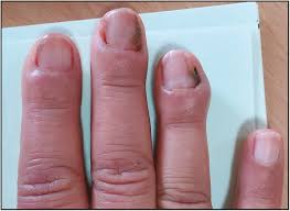 Image result for paronychium