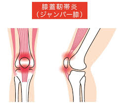 バスケ 膝 の 痛み