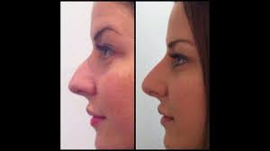 Dauerwerbesendunghallo meine lieben, herzlich willkommen zu meinem neusten video. Nasenkorrektur Ohne Op Youtube