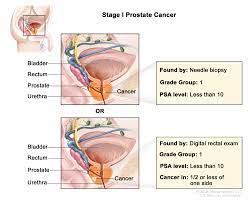 Survival rates for prostate cancer. Prostate Cancer Treatment Pdq Patient Version National Cancer Institute