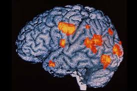 Ucla brain researchers using a powerful new technique have created the first images showing the devastating impact of schizophrenia on the brain. Schizophrenia And Inflammation Link Could Lead To New Treatments New Scientist