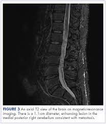 Intramedullary Spinal Cord And Leptomeningeal Metastases Presenting As Cauda Equina Syndrome In A Patient With Melanoma Mdedge Hematology And Oncology
