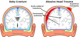 Define Abusive Head Trauma
