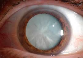 Cataracts are cloudy areas in the lens of the eye that can cause changes in vision. Advanced Cataract Surgery Schefkind Eye Care