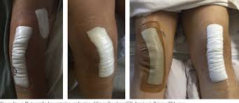 Image result for Occlusive Dressing