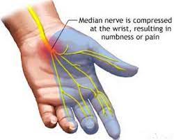Paresthesia Causes, Symptoms & Treatment | What Is Paresthesia? | Study.com