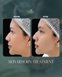 Radiant and rejuvenated! 🌟 With Tosca Skin Reborn featuring Sylfirm X at  Tosca Clinic, get a smooth, even-toned skin and softened wrinkles. Ready to  experience the magic for yourself? DM us now! #