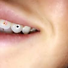 Our tooth jewelry is 100% reversible. Bay Area Tooth Gems 45 Photos Piercing 1939 Alum Rock Ave San Jose Ca Phone Number