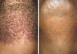Prp therapy for hair loss. Laser Hair Removal Reduce Unwanted Hair Dallas Fort Worth Texas