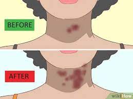 3 Ways To Treat A Rash On The Neck Wikihow