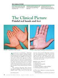 These mediators might promote palmar erythema (pe), and the aim of the present study was to investigate the vasodilation of palmar skin capillaries and angiogenesis, mainly with tumors of the central nervous system. Pdf Painful Red Hands And Feet