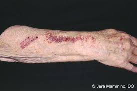 In older adults, this type of bleeding is called senile purpura. Bruising Hands And Arms American Osteopathic College Of Dermatology Aocd