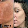 Leave acne to the experts — get acne care from a real provider with 1 short quiz. 3