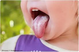 Learn about symptoms and risk factors. Oral Thrush In Babies