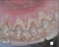 Braces are applied to teeth to align and straighten them.1 x trustworthy source mayo clinic educational website from one of the world's leading hospitals go to source these devices i always get a lot of plaque on my teeth with braces, but this article helped me a lot with what i should do! Do You Know What Plaque Is And How It Builds Up Angel Orthodontics