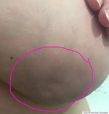 Symptoms of inflammatory breast cancer can develop rapidly, and the disease can progress quickly. Breast Cancer Patient Shares Candid Photo Of The Tiny Dimples Which Alerted Her To Cancer Huffpost Uk Life