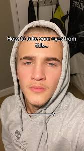 Orbicularis Oculi Muscle Before and After