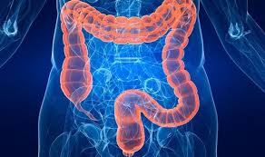 Edad Y Antecedentes Factores De Riesgo Para Cancer De Colon