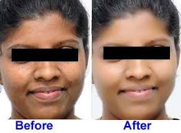 Before And After Black And White Bleaching Cream Reviews Pin On بشرتي