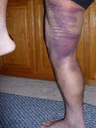 Adverse Effects Tourniquet Knee Replacement Portsmouth Nh