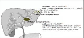 Sin senos no hay paraíso. Expanding Indications For Liver Transplantation In The Era Of Liver Transplant Oncology