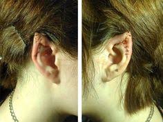 Pixie ear correction procedure explained. 8 Body Mod Ideas Body Body Mods Body Modifications