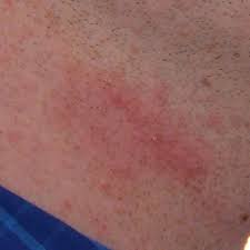 How To Eliminate Razor Burn And Irritation From Electric Shavers •  Shavercheck