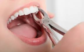 Ce Trebuie Sa Fac Dupa O Extractie Dentara Cat Costa Extractia De Masea
