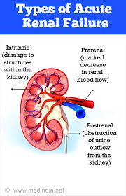 Later, symptoms may include leg swelling, feeling tired, vomiting, loss of appetite, and confusion. Acute Renal Kidney Failure Causes Symptoms Diagnosis Treatment And Complications