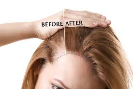 All chemo drugs don't cause hair loss, also called alopecia. Things You Should Know About Starting Chemotherapy Nawho