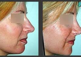 Rhinoplasty Beverly Hills