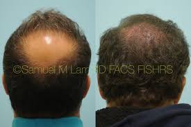 Typically, there is progressive loss and thinning of hair in an easily recognizable. Dallas Crown Vertex Hair Restoration Before And After Photos Plano Plastic Surgery Photo Gallery Dr Samuel Lamcrown Vertex Hair Restoration Archives Lam Sam Hairtx Com