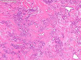 Malignant mesothelioma, a neoplasm arising within the serosal. Webpathology Com A Collection Of Surgical Pathology Images