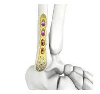 Itval Distal Lateral Fibular Locking Plate,Medical Device ...