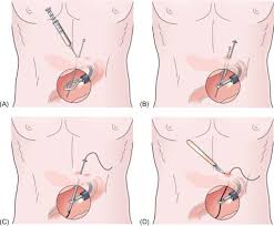 It is surgically placed directly into the small bowel, utilizing the witzel tunnel technique for secure placement and to help minimize leakage. Jejunostomy An Overview Sciencedirect Topics