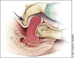 Cara mengobati miom di rahim secara tradisional tanpa operasi. Cuci Rahim Selepas Keguguran Secara Tradisional Malayhan