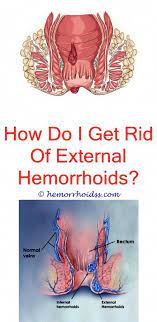 Internal hemorrhoids just started with the symptoms unobvious, so some people are often negligent about it. How Long Do Hemorrhoids Take To Form How Long Do Hemorrhoids Take To Form How To Make Hemorrhoids Go B Hemorrhoids Cure For Hemorrhoids Hemorrhoids Treatment