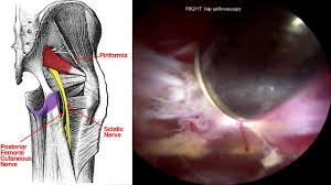 Endoscopic Sciatic Nerve Decompression For Deep Gluteal Syndrome Prone And Supine Approaches Youtube