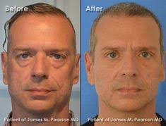 Acworth Georgia Blepharoplasty Surgeons Eyelid Surgery Double Eyelid Surgery
