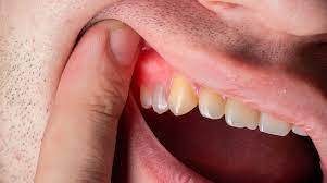 abscess in the mouth 