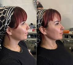 This girl came in for a half syringe then ended up coming back to add  another half! She has the most gorgeous natural lip shape and we just added  some luscious volume! #