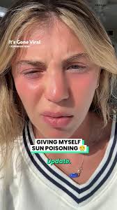 Girl Accidentally Falls Asleep In The Sun 😱