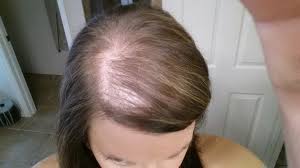 In this video we will let you know as if all the other body changes women go through during pregnancy aren't enough, hair loss during pregnancy can almost. Pregnancy And Hair Loss Or Thinning Photo