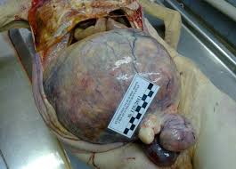 Рак желудка и яичников  autopsy :: morbid :: xxx-files  funny cocks &  best free porn: r34, futanari, shemale, hentai, femdom and fandom porn