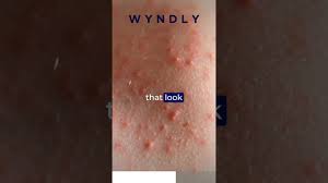 Image result for flea bite