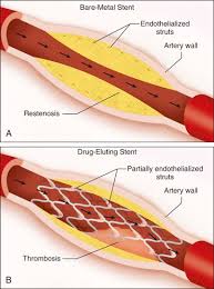 I just don't want it to be fried when i go to develope the pictures. Imaging Of Coronary Revascularization Coronary Stents And Bypass Grafts Radiology Key