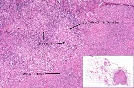 In necrosis, however, the body isn't prepared to remove the dead cells, and as a result, causes an inflammatory response. Necrosis Pathologia